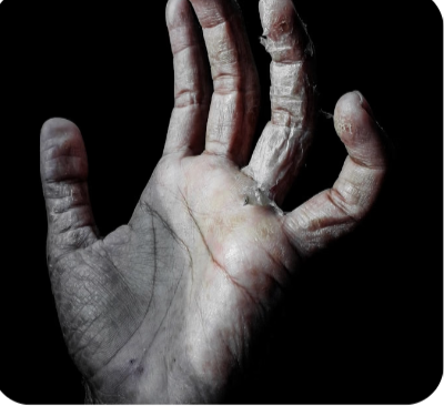 Neurological Hand Disorders